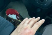 被蜂蛰了怎么办消肿？紧急处理和后续护理方法是什么？