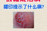 拔罐后出现水泡怎么办？有效处理方法是什么？