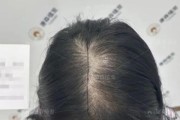 女人为什么脱发严重？如何有效预防和治疗？