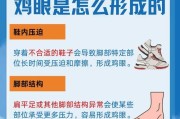 脚上鸡眼怎么治才能消失？有效治疗方法有哪些？