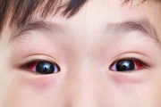 电焊闪眼后如何快速缓解？有效预防措施有哪些？