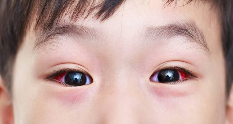 电焊闪眼后如何快速缓解？有效预防措施有哪些？