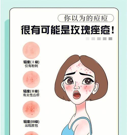 酒糟鼻是怎么引起的？如何预防和治疗？