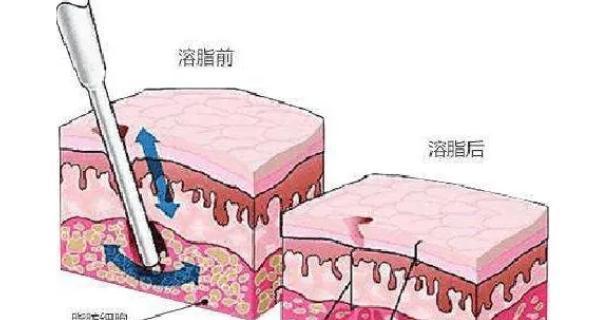 身体皮肤松弛怎么办？有效紧致肌肤的方法有哪些？