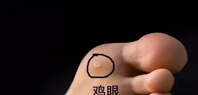 脚上鸡眼怎么治才能消失？有效治疗方法有哪些？