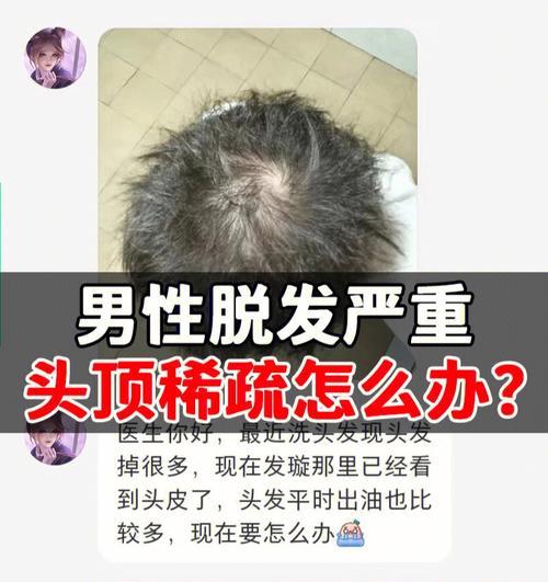 前面头发稀少怎么办？有效改善方法有哪些？