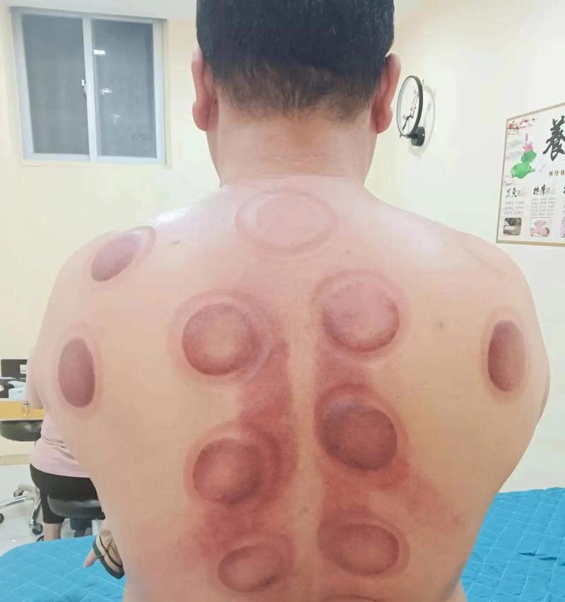 拔罐后出现水泡怎么办？有效处理方法是什么？